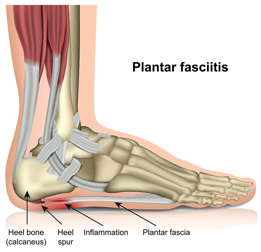 how to treat plantar fasciitis track symptoms with the best life app